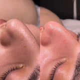 HydraFacial
