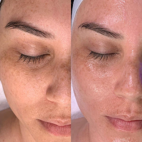 HydraFacial