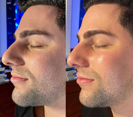 HydraFacial
